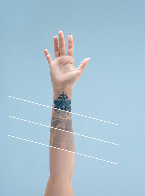 Tattoo Removal Bromley
