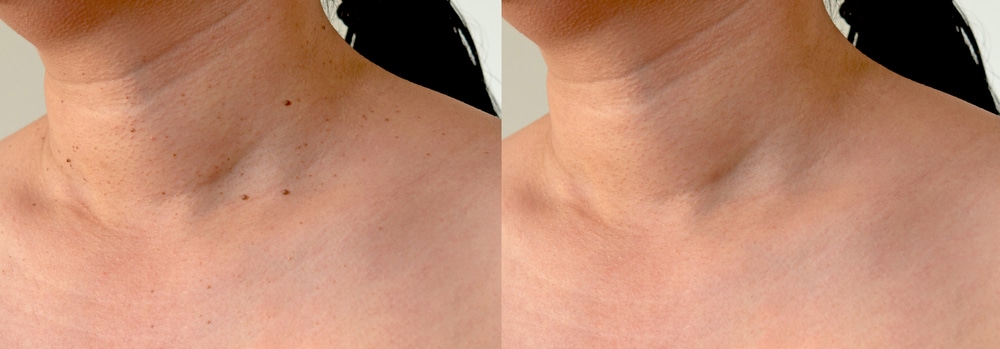skin tag removal bromley