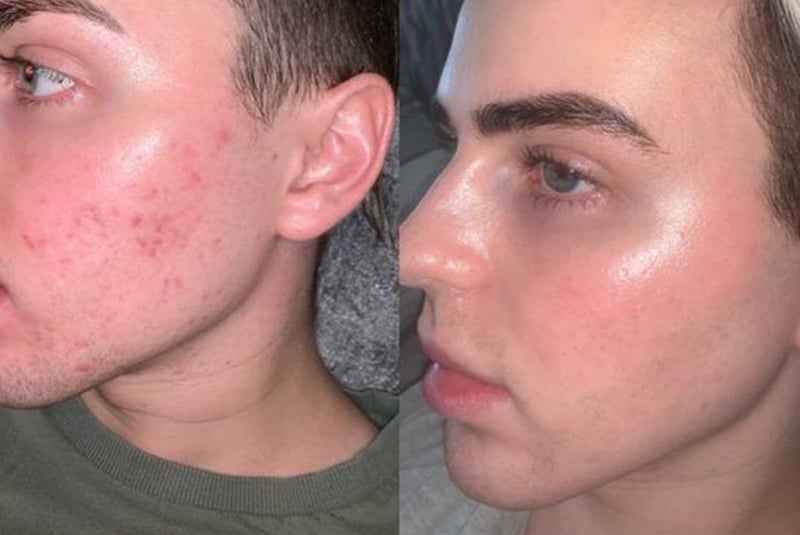 Acne Before After Treatment London