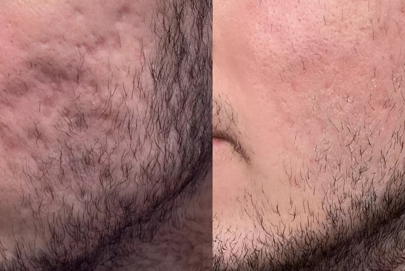 Acne Scarring Before After Treatment Bromley