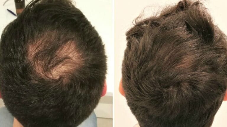 Hair Loss Treatment London Bromley