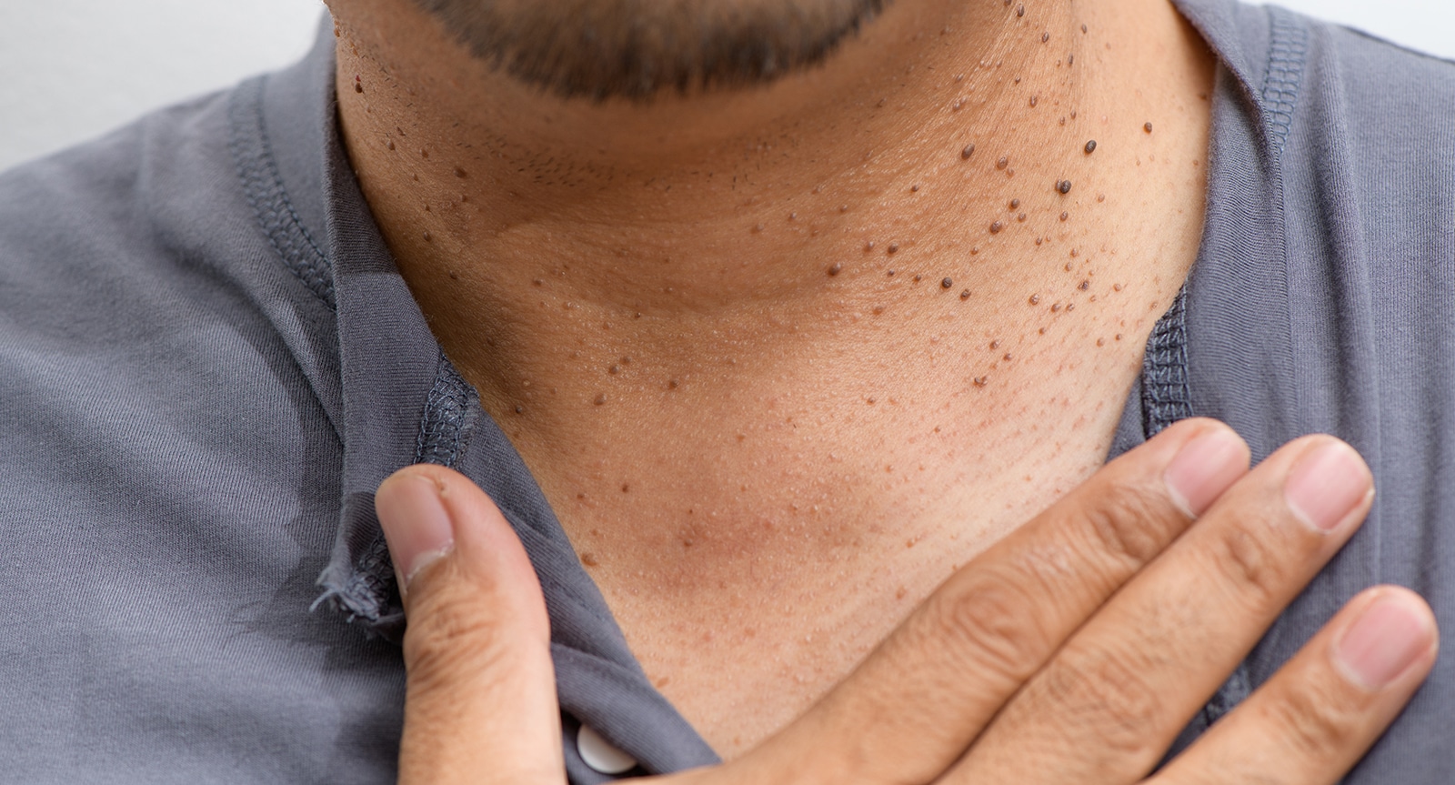 skin tag removal bromley