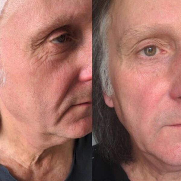 Before and after Morpheus8 Face Treatment Results Bromley