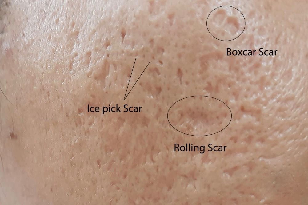 Acne Scar Treatment Bromley