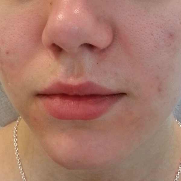 Is Green Peel Worth It? Complete Benefits & Results Guide 2025 Green Peel After Bromley