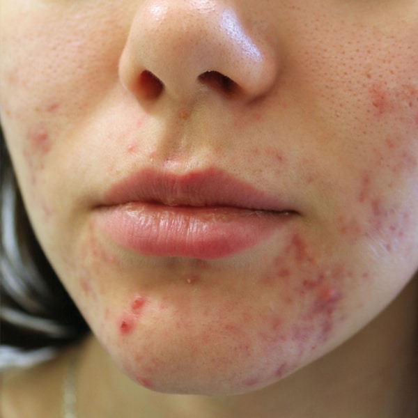Is Green Peel Worth It? Complete Benefits & Results Guide 2025 Green Peel Before Bromley