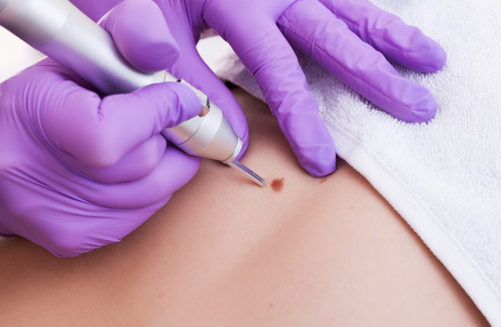 skin tag removal