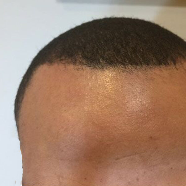 Laser Hair Removal for Dark Skin Hair Free in 6 8 Sessions!