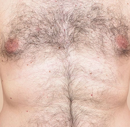 Laser Hair Removal for Men Before After