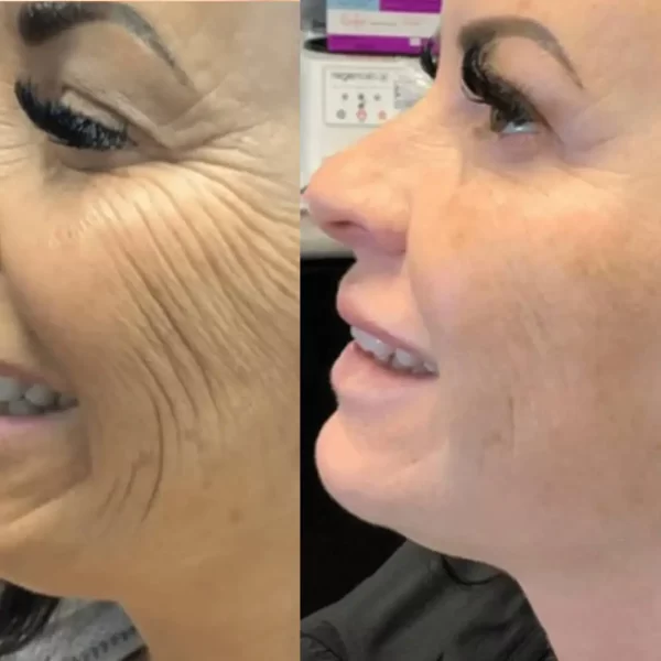 Morpheus8 anti-aging anti-wrinkle firming lifting tightening treatment available in Bromley South East London