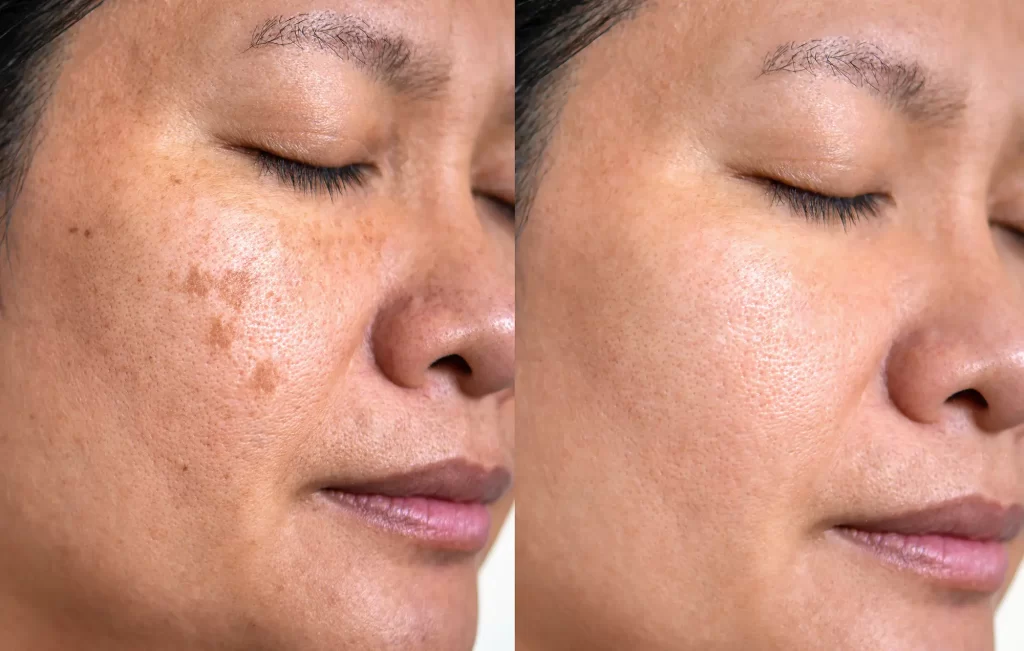 Cosmelan Depigmentation Peel