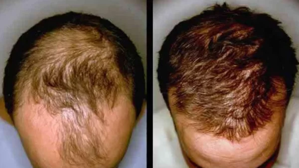 PRP Hair Treatment - Image 11