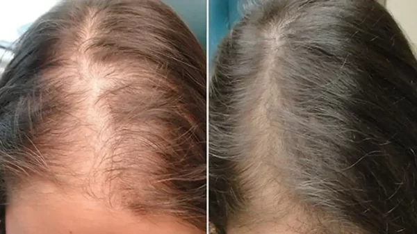 PRP Hair Treatment - Image 8