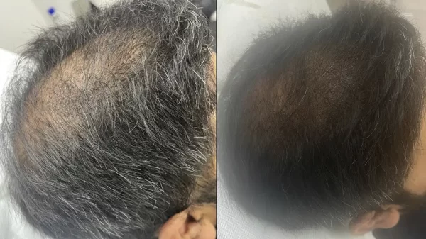 PRP Hair Treatment - Image 3