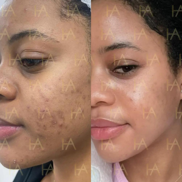 PRP hyperpigmentation treatment before & after results