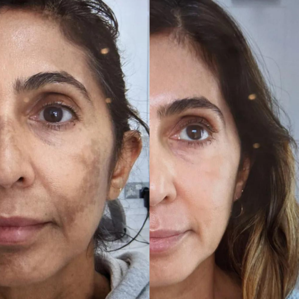 PRP hyperpigmentation treatment before & after results