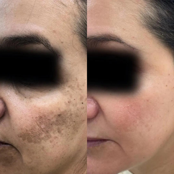 PRP hyperpigmentation treatment before & after results