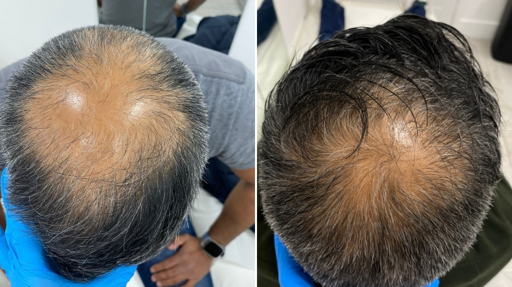 before and after photo for hair loss treatment