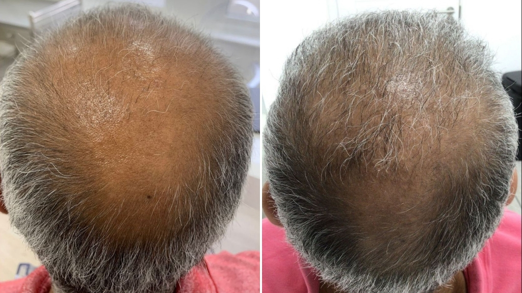 before and after photo for hair loss treatment