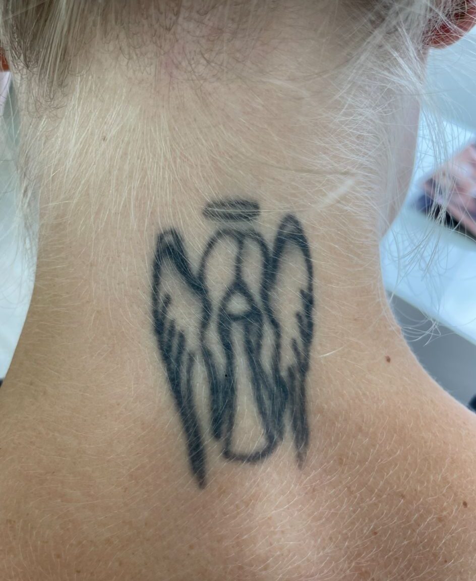 tattoo removal before photo
