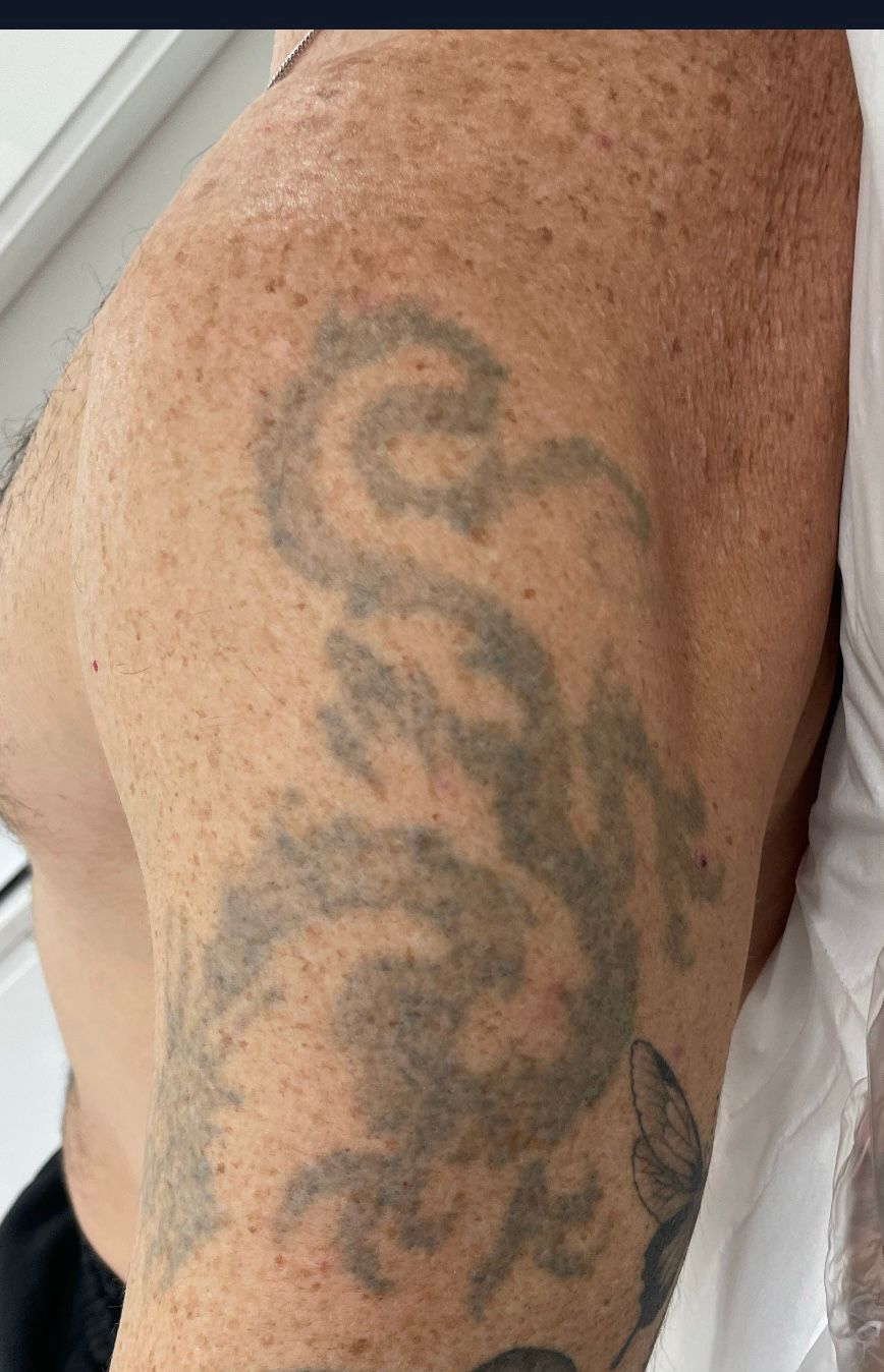 tattoo removal after