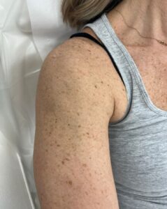 Pigmentation Removal Bromley Before IPL treatment shoulder photo