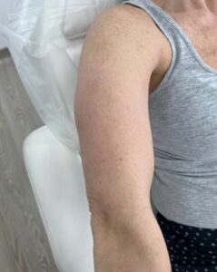 After IPL treatment shoulder photo