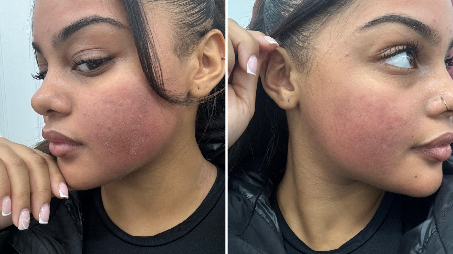 Green Peel Journey - After The Treatment