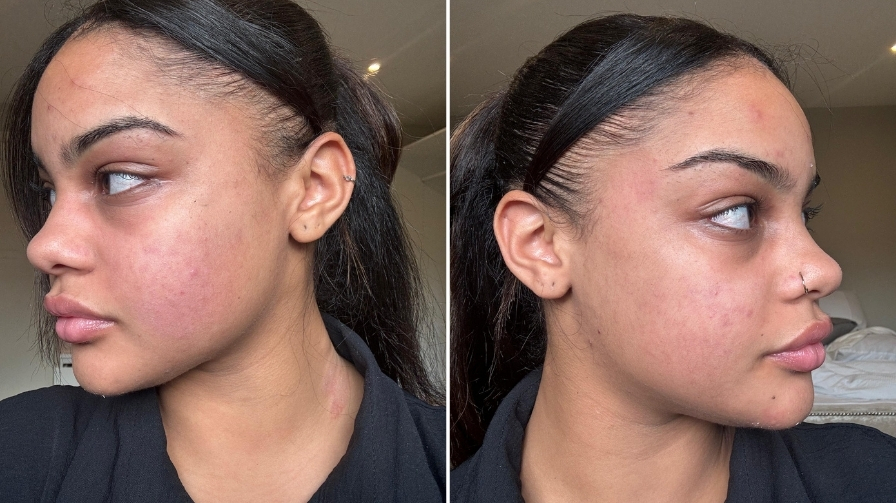 My 5-Day Green Peel Journey: Transforming My Skin - House of Aesthetics ...