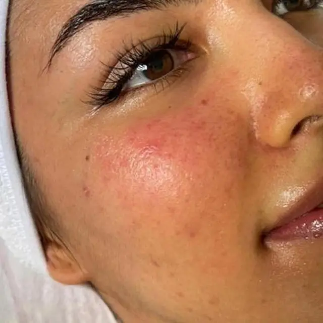 acne after dermalux triwave