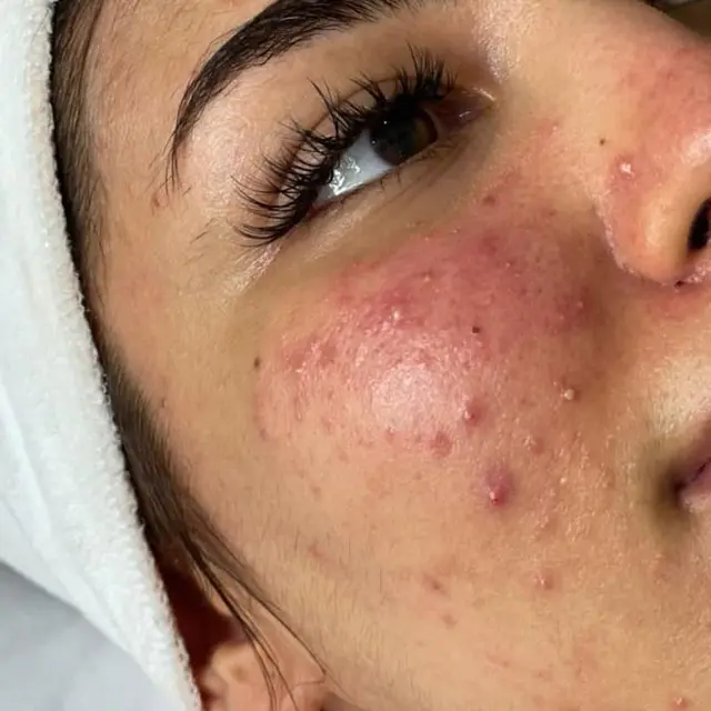 acne before dermalux triwave