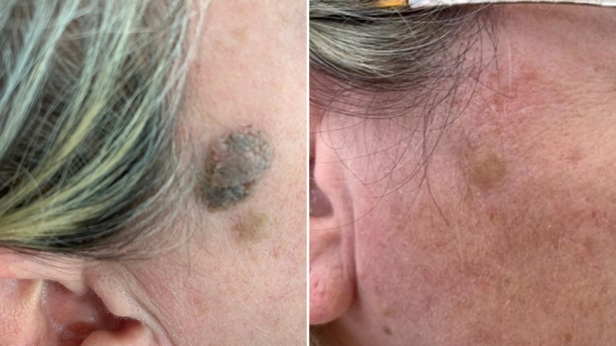 Before and After Electrolysis Treatment