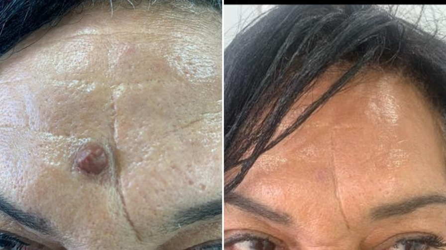 Before and After Electrolysis Treatment