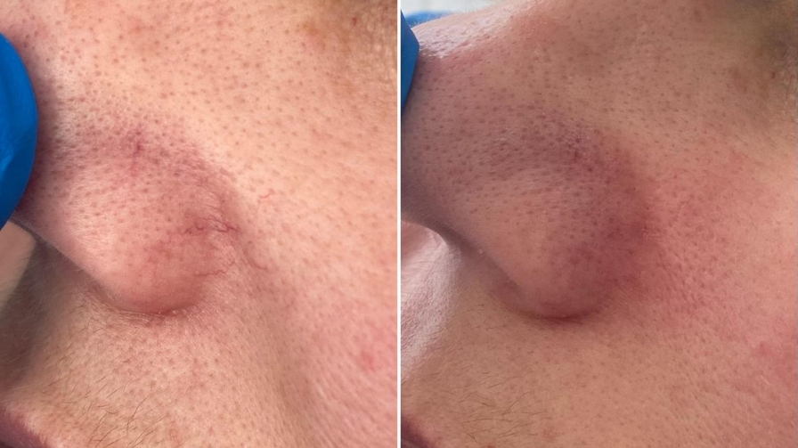 Before and After Electrolysis Treatment