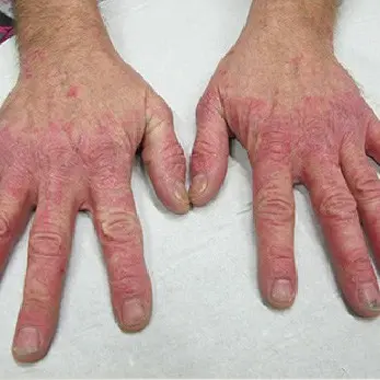 psoriasis before dermalux triwave