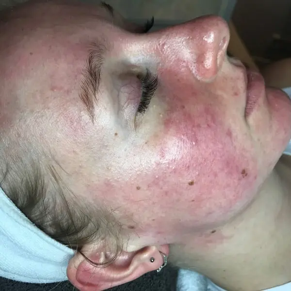 redness before dermalux triwave