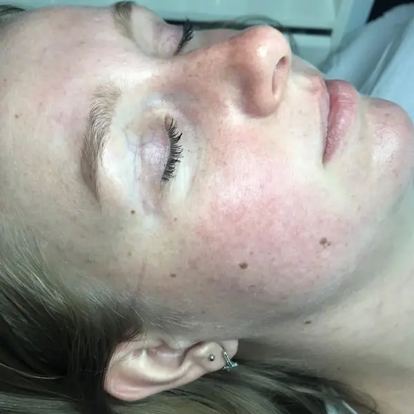 redness after dermalux triwave