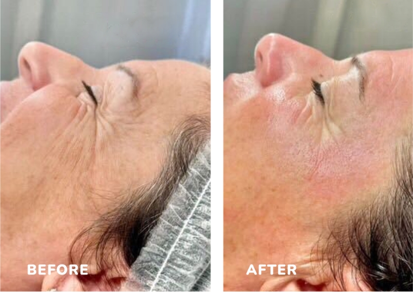 Microneedling Imedpen Before and After
