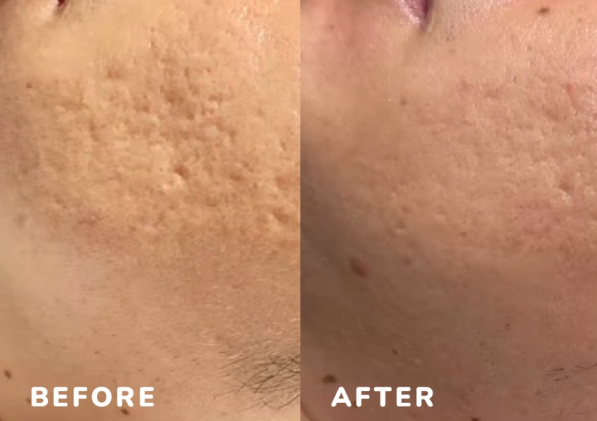 Microneedling Imedpen Before and After