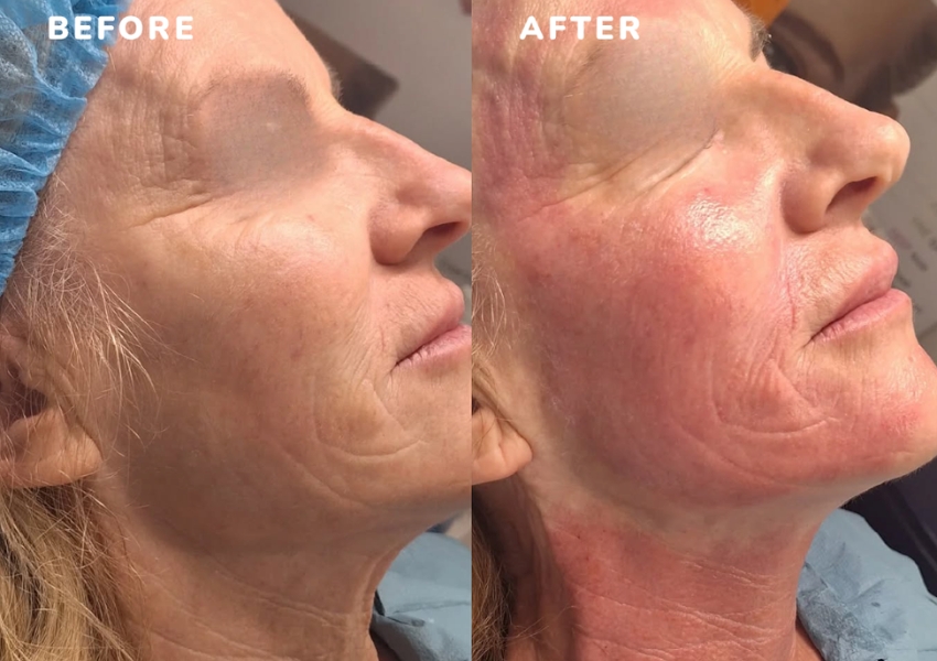 Microneedling Imedpen Before and After