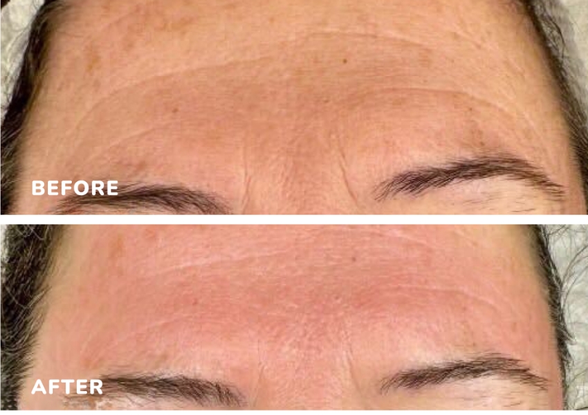 Microneedling Imedpen Before and After