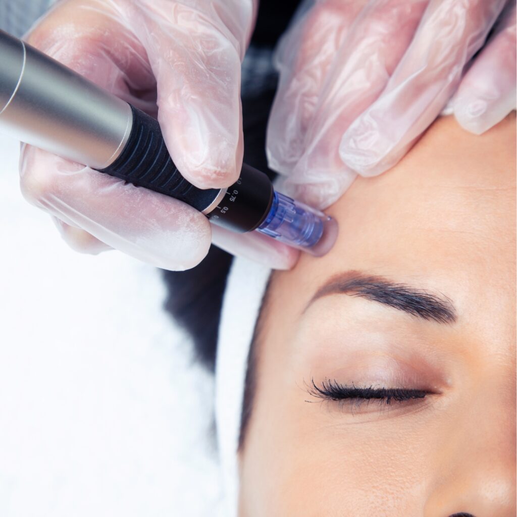 microneedling bromley