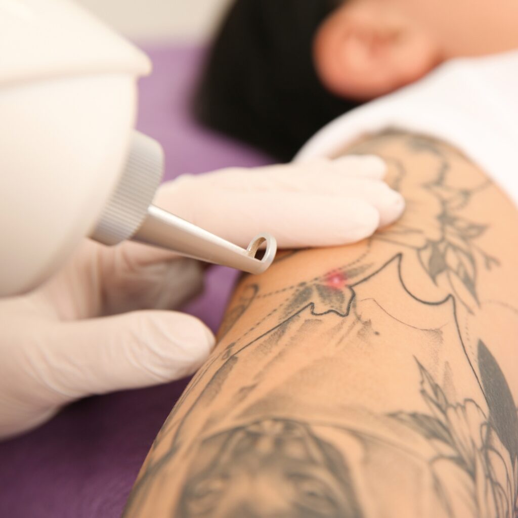 Laser Tattoo Removal
