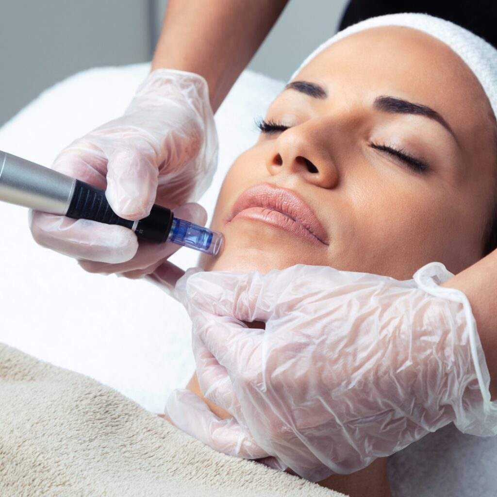 microneedling treatment bromley