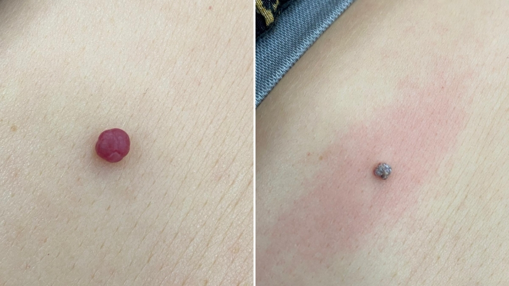 Electrolysis Cherry Angiomas Before and After