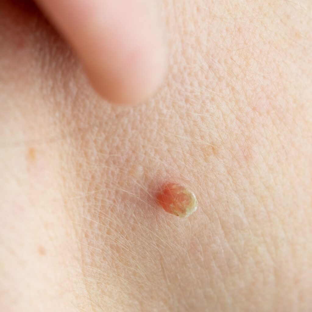skin tag removal bromley