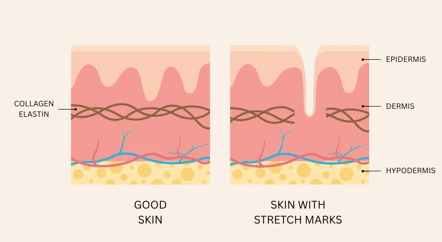 what causes stretch marks