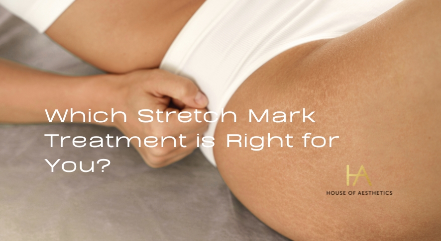 Which Stretch Mark Treatment is Right for You?