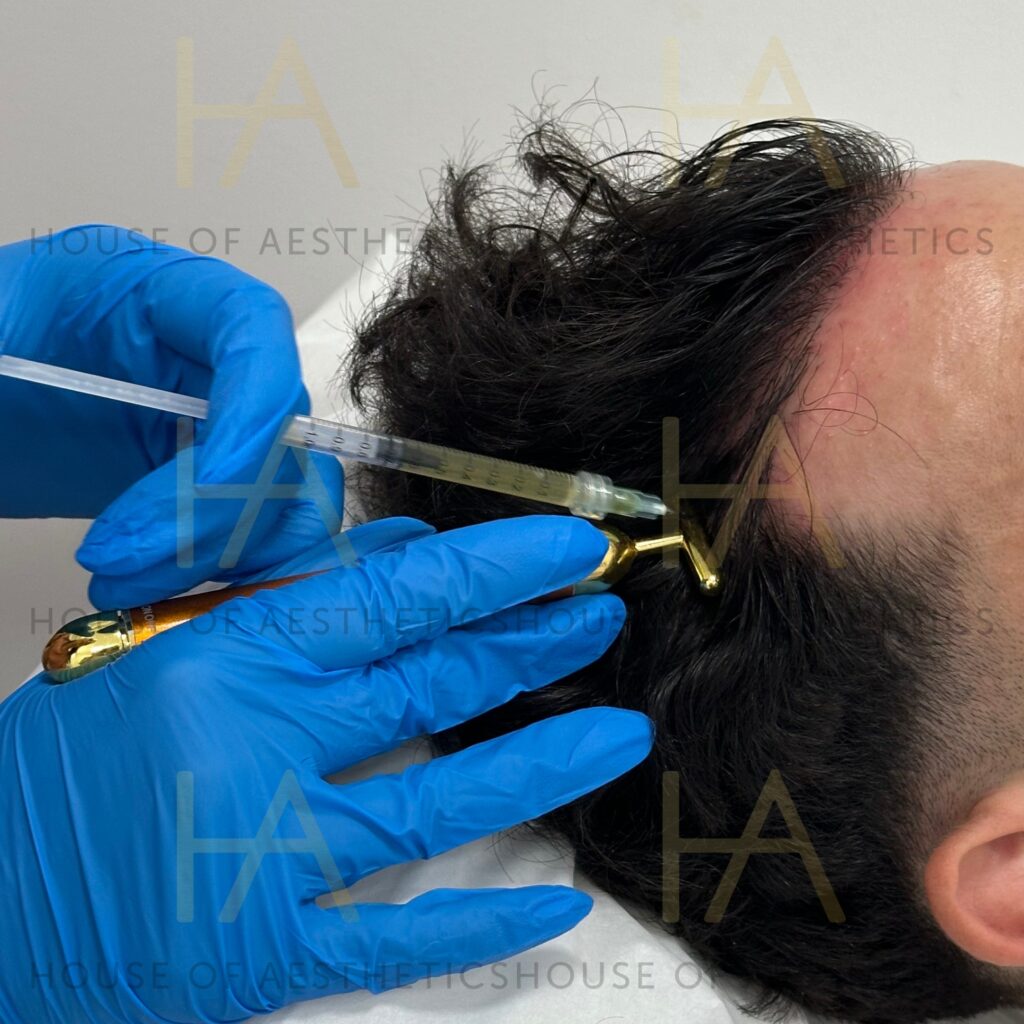 PRP Hair Loss Treatment Bromley