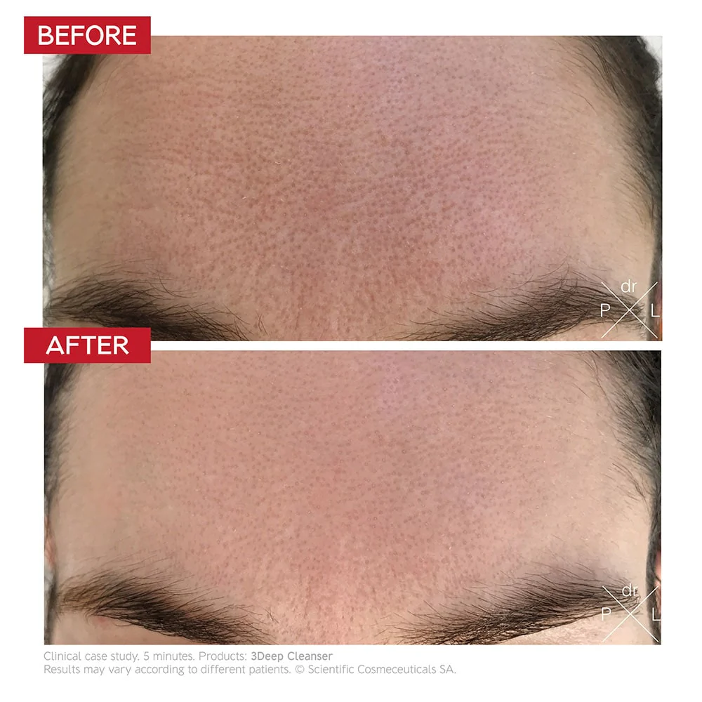 dr-levy-switzerland-skin-care-beauty-product-3deep-cleanser-before-after